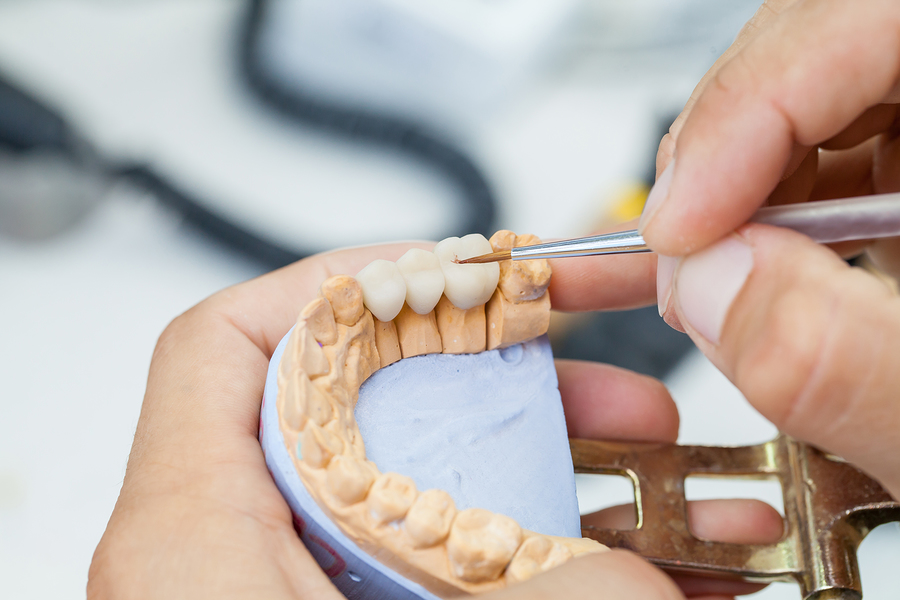 Getting a Dental Crown? Hereâ€™s What You Can Expect