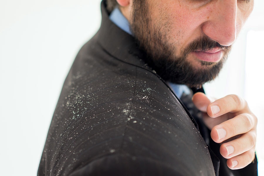 How To Deal With Dandruff and Itchy Scalps
