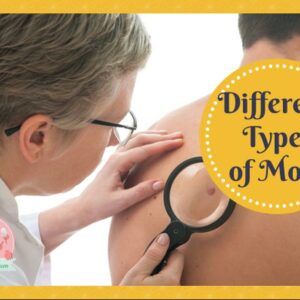 Different Types of Moles