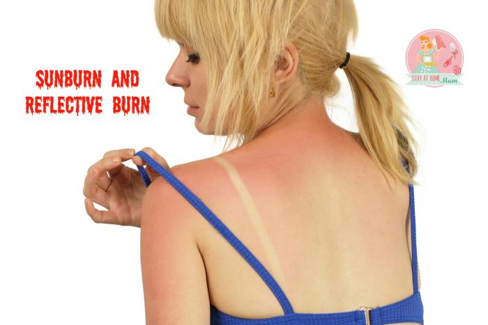 Sunburn and Reflective Burn