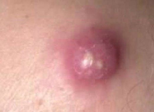Large Red Bump On Penis 105
