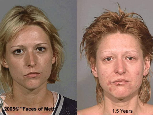 Before and After - 18 Months of Meth Use