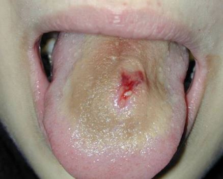 Pain scale piercing tongue Frenulum Piercing