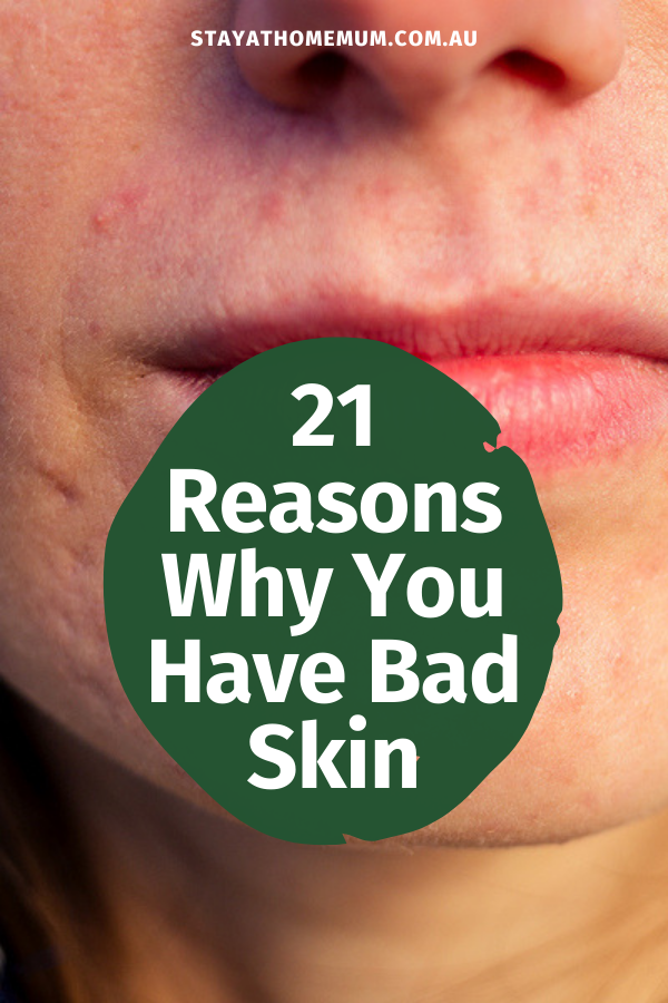 21 Reasons Why You Have Bad Skin | Stay at Home Mum