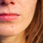 bigstock Post acne Scars And Red Feste 325661503 | Stay at Home Mum.com.au