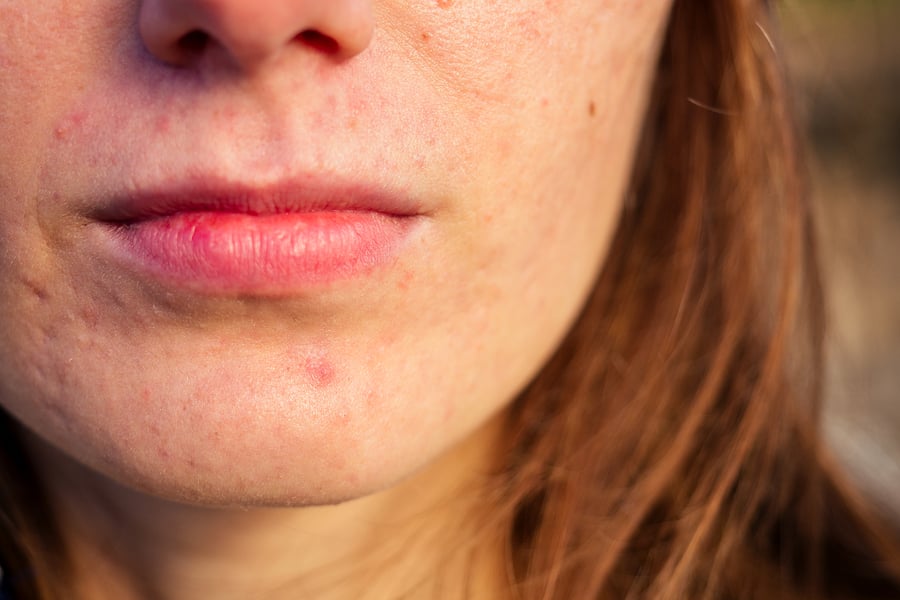 21 Reasons Why You Have Bad Skin