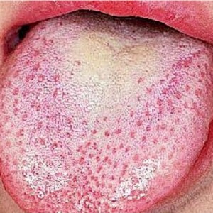 Scarlet Fever – What Is It?