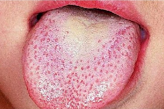 Scarlet Fever – What Is It?