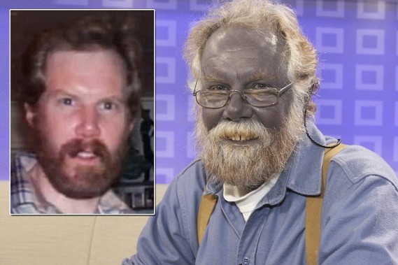 The Mystery Of The Blue-Skinned Colloidal Silver Drinkers