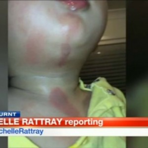 Toddler Gets Second Degree Burns At Day Care