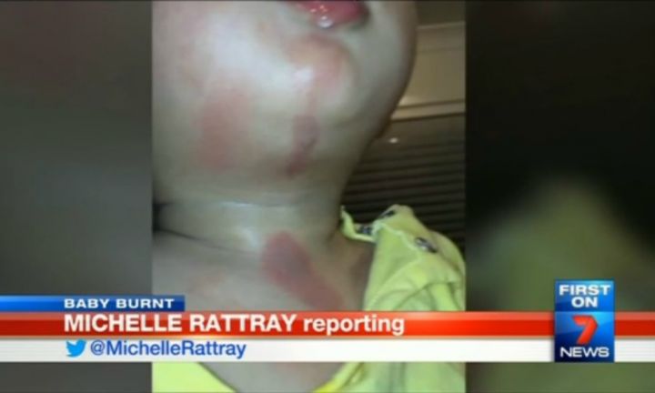 Toddler Gets Second Degree Burns At Day Care
