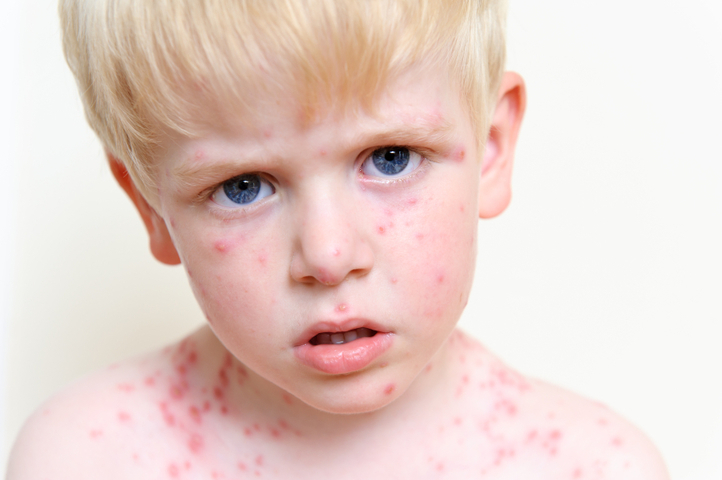80 Kids Contract Chickenpox At One School