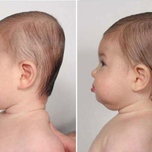 More Parents Ignore SIDS Guidelines to Prevent Flat Head Syndrome