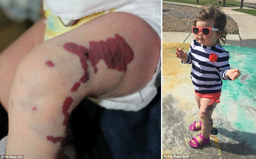 Two-Year-Old Girl Has Too Many Veins And Could Develop Fatal Blood Clot