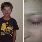 Eight-Year-Old Boy Underwent Surgery To Save His Eyesight After Horrific Magpie Attack | Stay at Home Mum