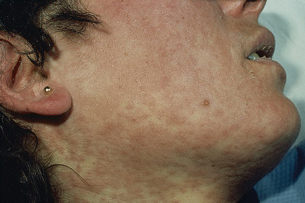 Man Carrying Measles From Tokyo to Perth Puts Hundreds At Risk