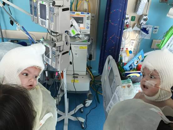 Conjoined Twins Finally Look At Each Other After Mammoth 27-Hour Surgery | Stay At Home Mum