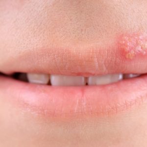 Everything You Need To Know About Herpes