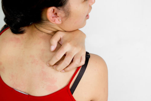 What You Need To Know About Keratosis Pilaris | Stay At Home Mum