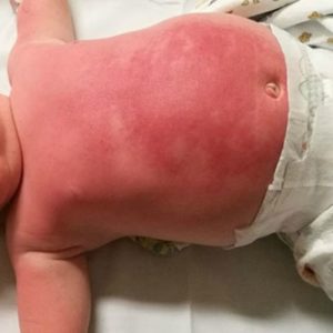 Baby Boy And Mum Suffer Severe Rashes and Burns Due to Sunscreen
