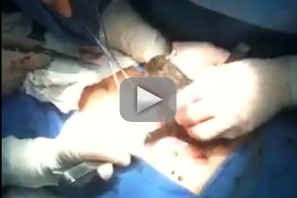 Incredible Video Shows Doctors Pull Out Hair Ball From Human Stomach!