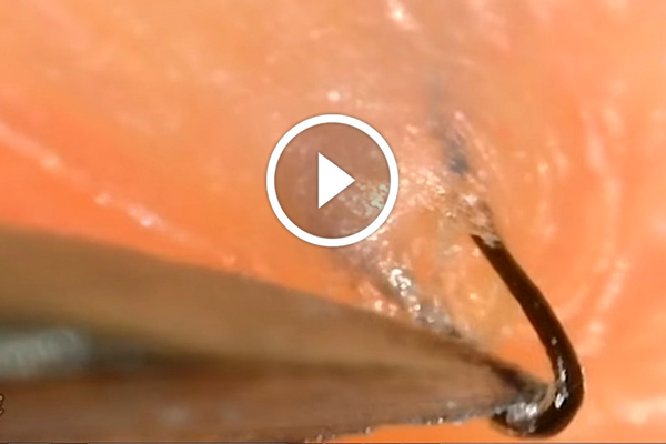 This Ingrown Hair Removal Video Is #Feels - Stay at Home Mum