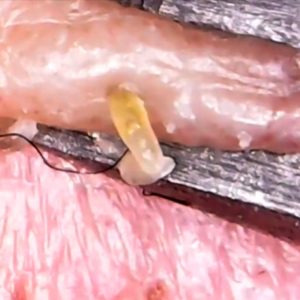 This Close-Up Blackhead Removal Video Will Make Your Day!