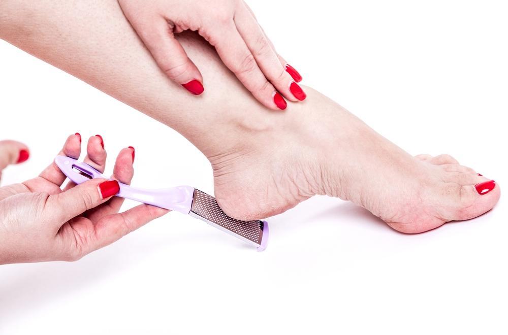 5 Easy Home Remedies for Cracked Heels