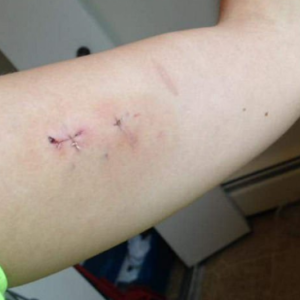 Mum Traumatised After Her Birth Control Implant Goes Missing Inside Her Arm