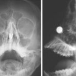 11-Year-Old Boy Hospitalised After Two Magnets Inside Each Of His Nostrils Snapped Together | Stay at Home Mum