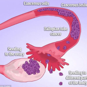 Study: Ovarian Cancer Begins In The Fallopian Tubes Six Years Before It Becomes Fatal