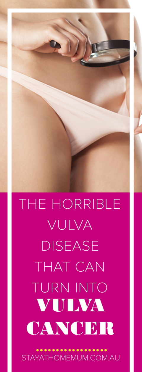 The Horrible Vulva Disease That Can Turn Into Vulva Cancer | Stay At Home Mum