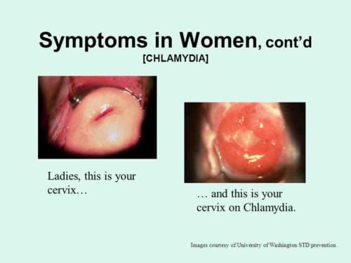 History, Symptoms and Treatment of Chlamydia | Stay At Home Mum