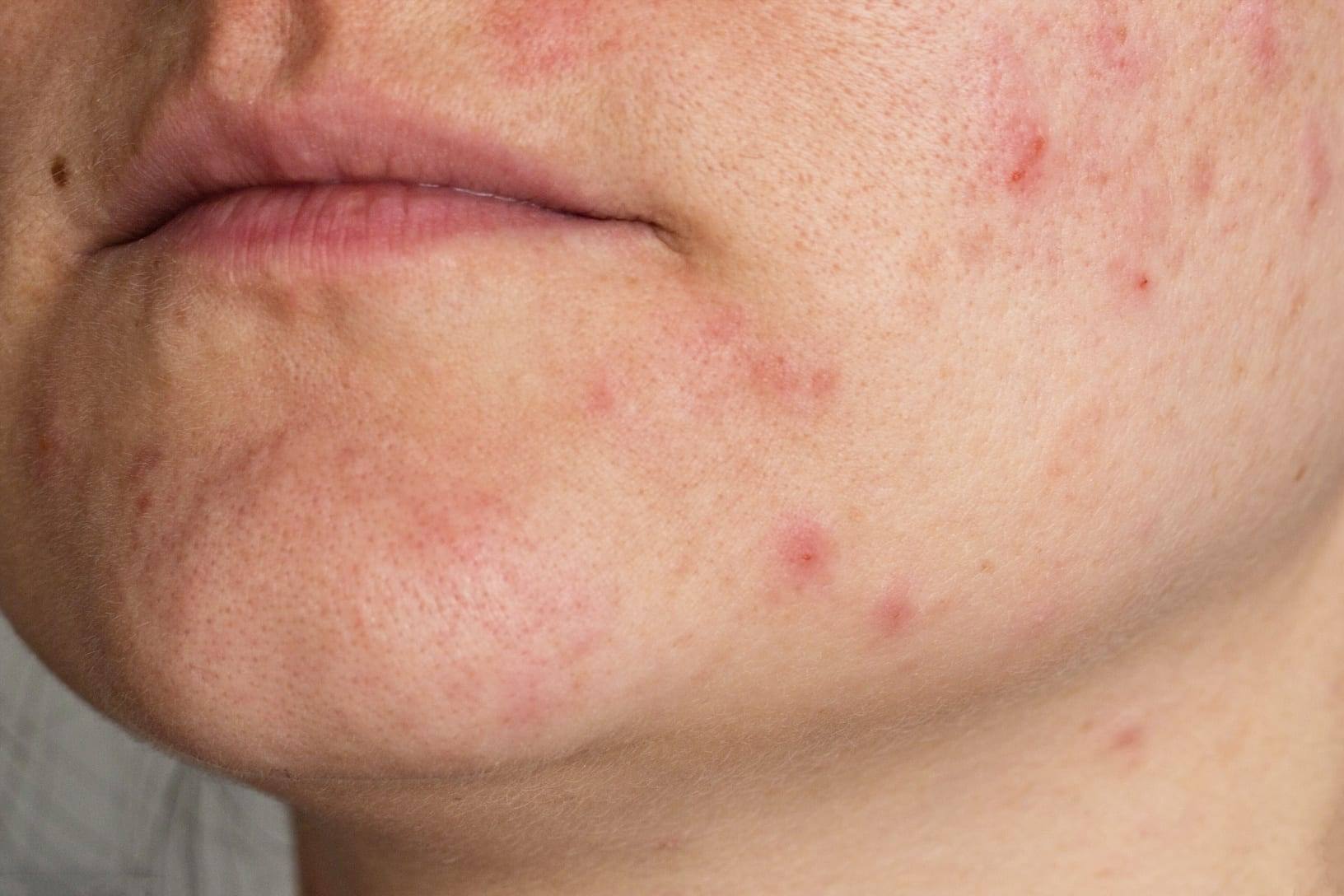 What To Do About Adult Acne