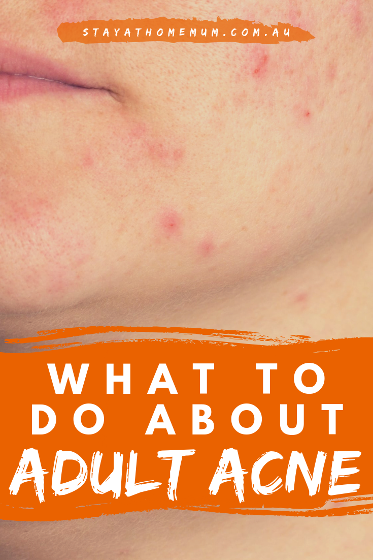 What to Do About Adult Acne | Stay At Home Mum