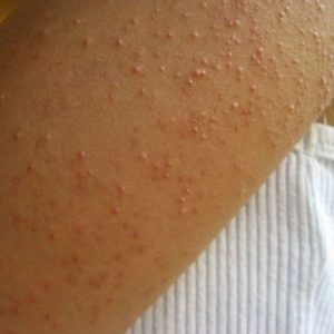 What You Need To Know About Keratosis Pilaris