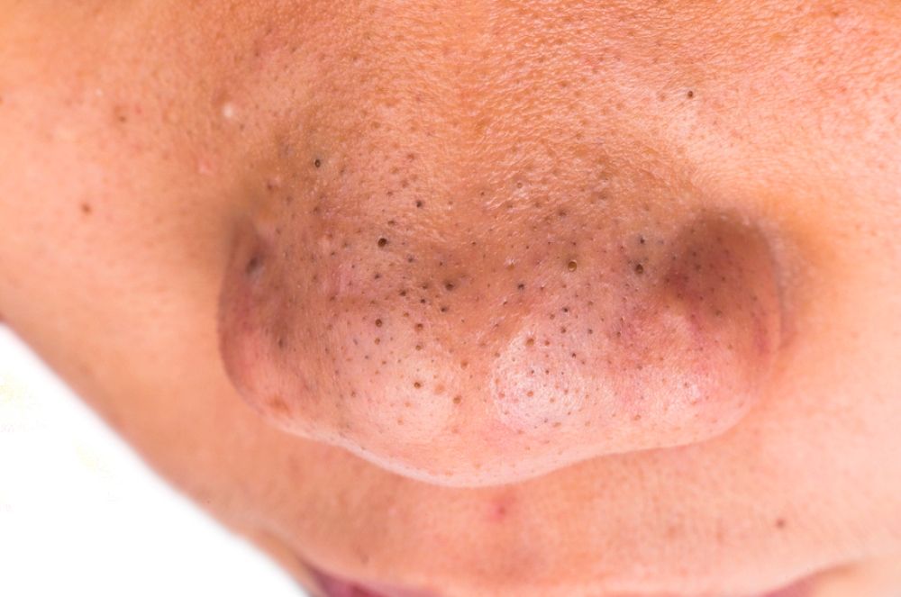 bigstock Close up on pimple blackheads 96785354