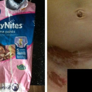 Do Huggies Nappies Cause Chemical Burns? The Internet is Saying YES