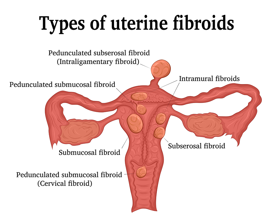 What You Should Know About Uterine Fibroids | Stay at Home Mum