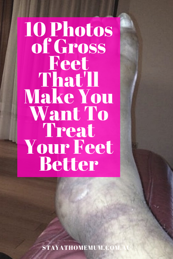 10 Photos of Gross Feet That'll Make You Want To Treat Your Feet Better | Stay At Home Mum