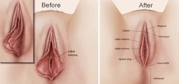labiaplasty diagram | Stay at Home Mum.com.au