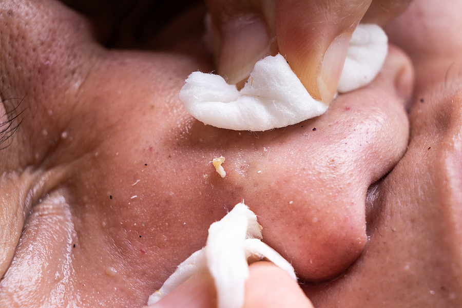 The Best Blackhead Treatments You Will Ever Need