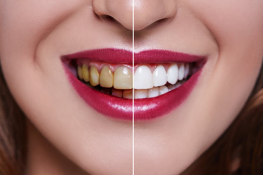 The Best Home Teeth Whitening Kits to Try