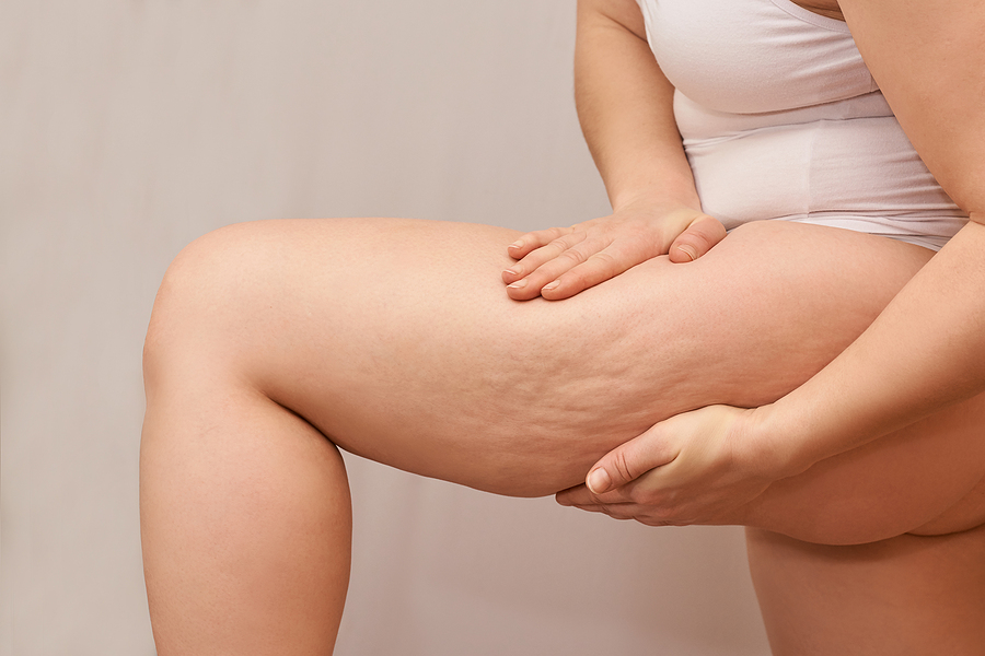 bigstock Cellulite Leg Woman Pinch Tes 366787915 | Stay at Home Mum.com.au