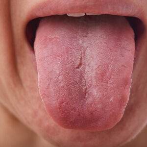 25 Disgusting Tongues and Medical Conditions Behind It