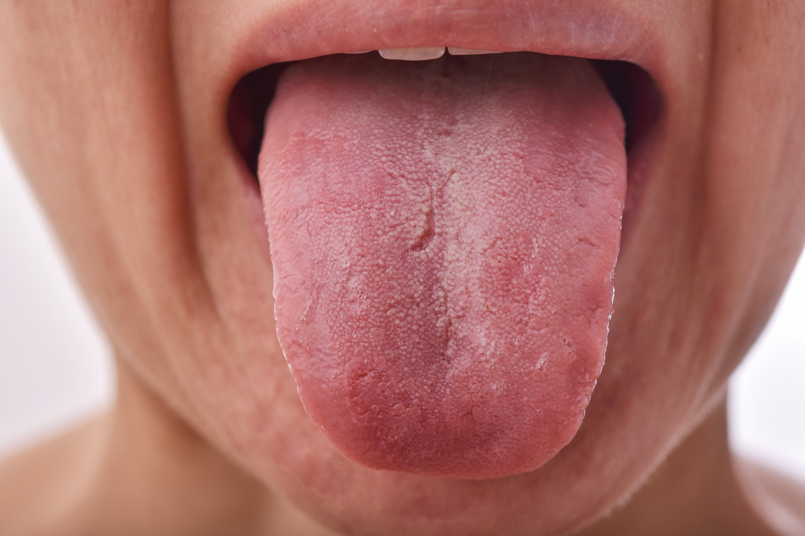 25 Disgusting Tongues and Medical Conditions Behind It
