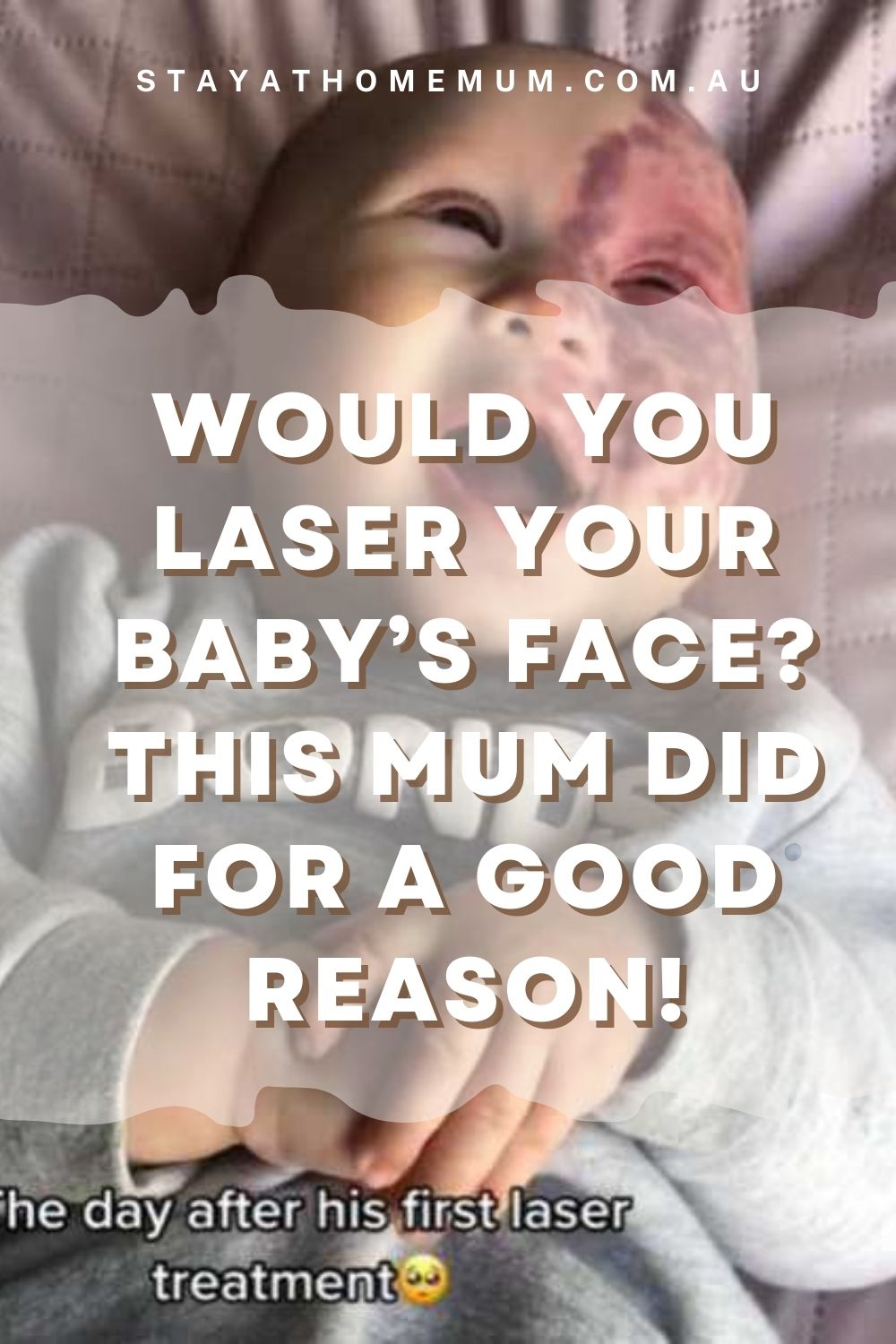 Would You Laser Your Baby's Face? This Mum Did I Stay at Home Mum