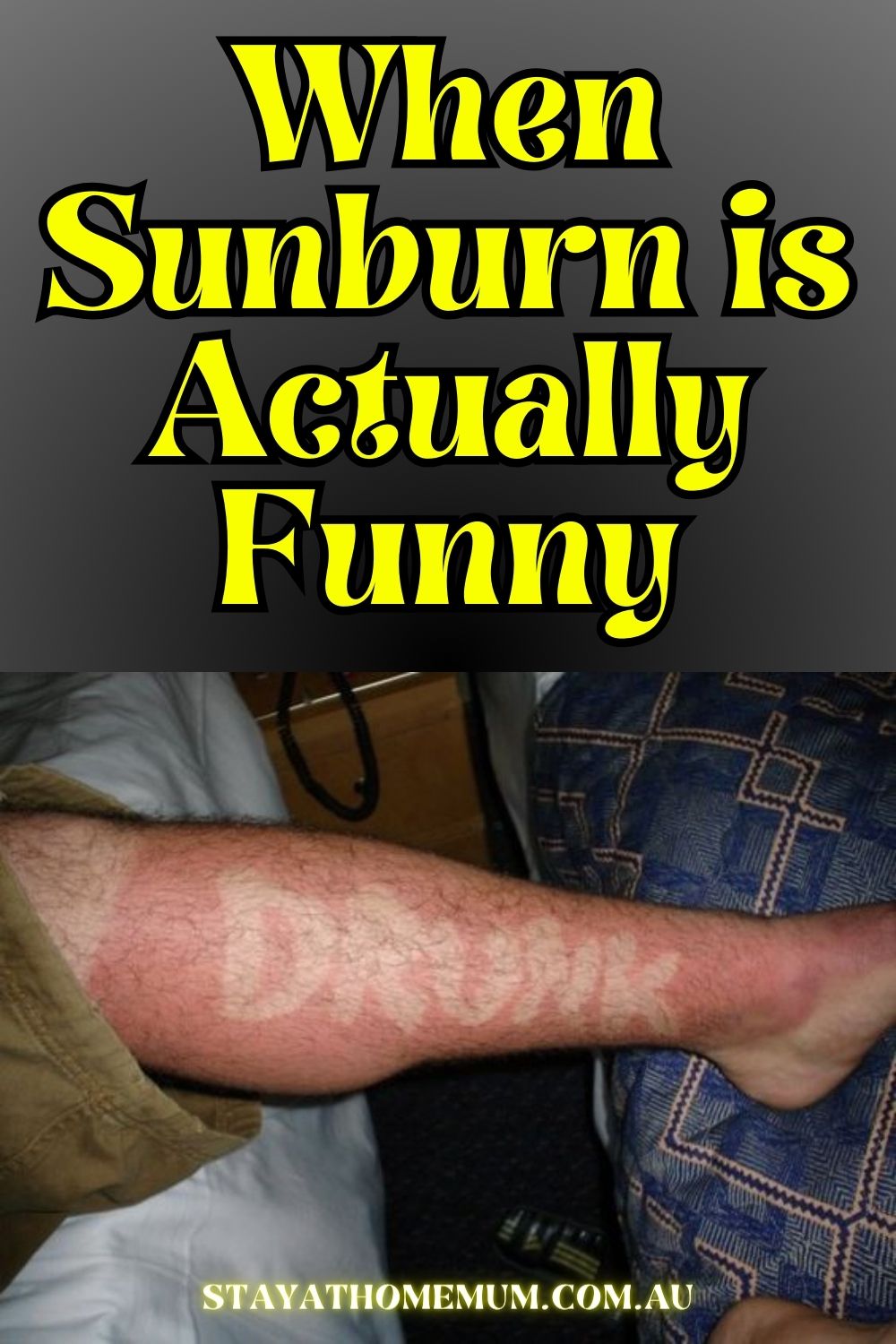 When Sunburn is Actually Funny Pinnable